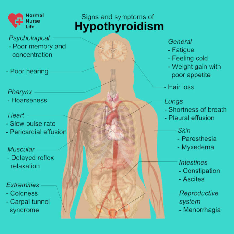 hypothyroidism case study nursing