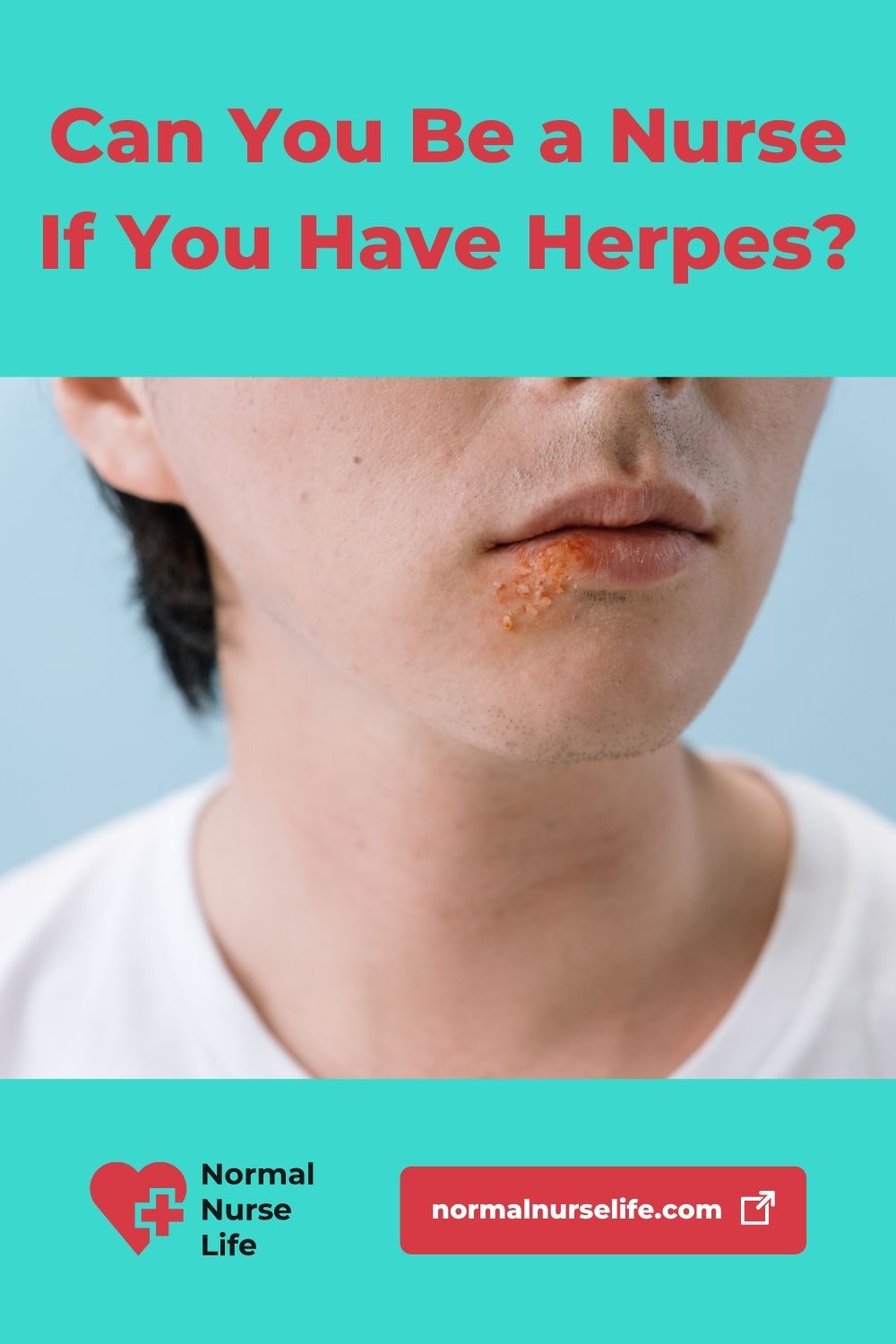 Can You Be a Nurse and Have Herpes?
